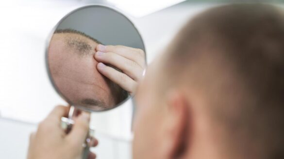 estos-son-los-tratamientos-mas-efectivos-para-la-alopecia