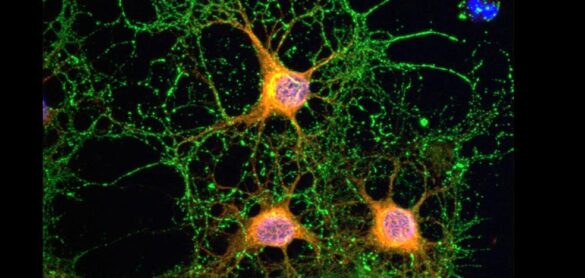 identifican-proteinas-que-provocan-la-muerte-de-neuronas-en-enfermos-de-alzheimer