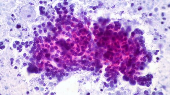 siete-signos-de-alerta-del-cancer-de-pancreas,-el-‘asesino-silencioso’