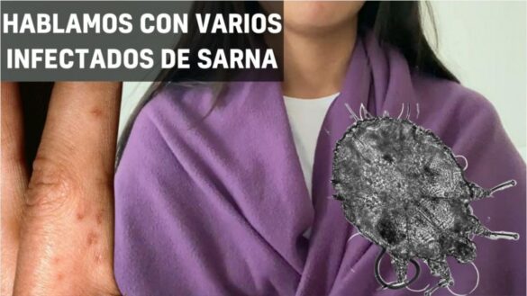 los-infectados-de-sarna-en-espana:-«son-como-picotazos-de-mosquito,-pero-pican-mucho»