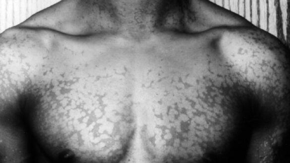 como-identificar-la-tina-versicolor,-un-problema-de-la-piel-provocado-por-el-sobrecrecimiento-de-un-hongo-comun