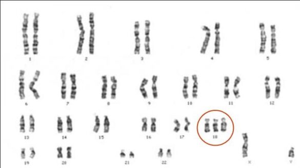 que-es-sindrome-de-edwards-o-trisomia-18,-sintomas,-causas-y-tratamiento