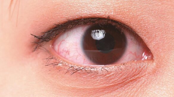 herpes-en-el-ojo,-asi-es-la-enfermedad-que-provoco-a-ibai-llanos-ceguera-del-70%