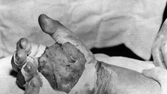 asi-es-la-enfermedad-que-produce-la-radiacion-en-un-accidente-nuclear