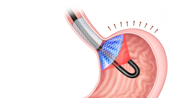 el-innovador-tratamiento-con-laser-e-implante-para-superar-la-obesidad-sin-necesidad-de-cirugia