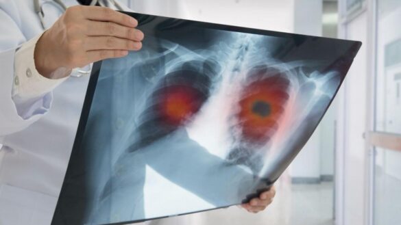 esperanza-contra-el-cancer-de-pulmon:-combinar-quimioterapia-y-el-farmaco-nivolumab-mejora-la-tasa-de-supervivencia