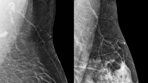 mamas-densas-y-con-dolor:-¿que-significa?-¿hay-un-mayor-riesgo-de-cancer?