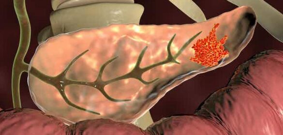 asi-hallamos-el-nuevo-biomarcador-para-detectar-de-forma-precoz-el-cancer-de-pancreas