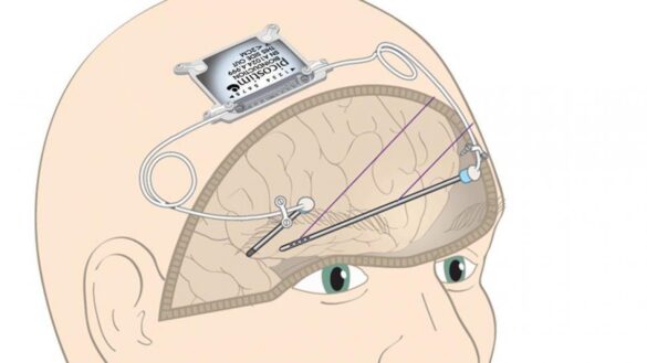 un-implante-cerebral-podria-revertir-los-sintomas-del-parkinson