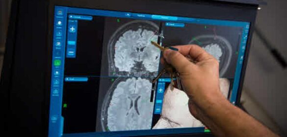 el-3%-de-la-poblacion-padecera-epilepsia