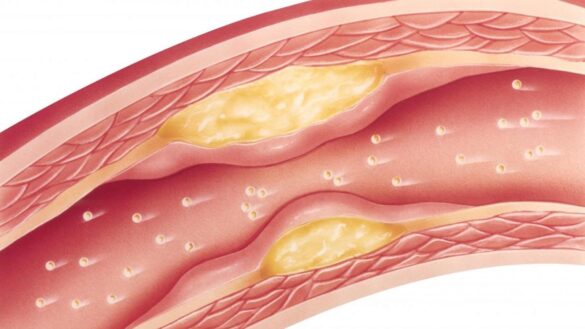 adios-al-colesterol:-una-tecnica-con-laser-y-ultrasonido-es-capaz-de-‘vaporizarlo’