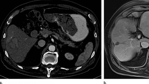 el-mayor-avance-en-una-decada-contra-el-carcinoma-hepatocelular,-uno-de-los-tumores-mas-agresivos