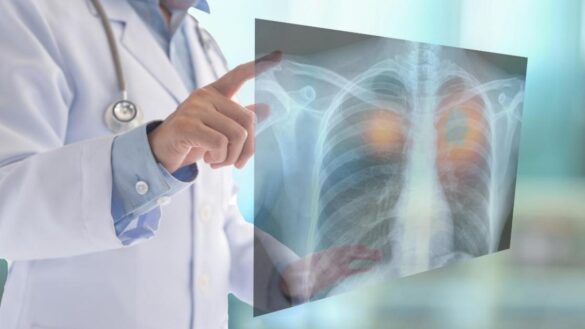 un-nuevo-tratamiento-contra-el-cancer-de-pulmon-multiplica-por-seis-la-erradicacion-de-los-tumores