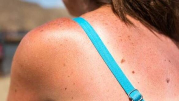 cuando-debes-empezar-a-preocuparte-por-una-quemadura-solar