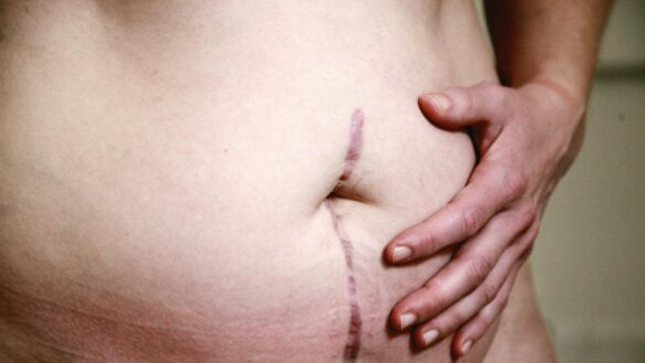 diagnostican-un-cancer-terminal-a-una-mujer-mientras-da-a-luz-durante-una-cesarea-tras-12-meses-de-dolor-abdominal
