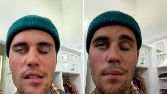 que-es-el-sindrome-de-ramsay-hunt-que-ha-paralizado-media-cara-a-justin-bieber