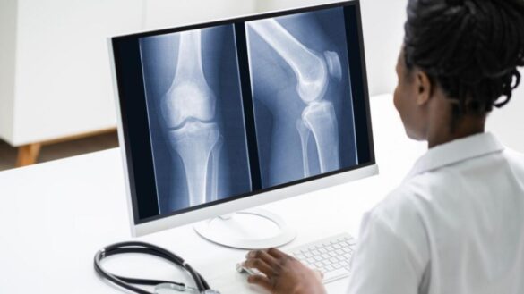 la-osteonecrosis,-una-enfermedad-insidiosa-que-suele-requerir-cirugia