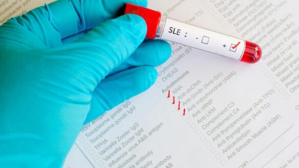 desarrollan-un-test-de-sangre-capaz-de-detectar-el-lupus