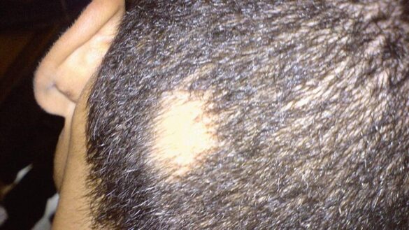 asi-es-el-primer-farmaco-para-la-alopecia-areata-severa