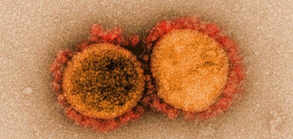 la-covid-19-provoca-mayor-riesgo-de-desarrollar-trastornos-neurodegenerativos