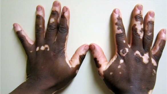 vitiligo,-asi-son-los-tratamientos-mas-efectivos-y-prometedores:-«estamos-mas-cerca-de-estabilizarlo-y-de-repigmentar-mas-casos»