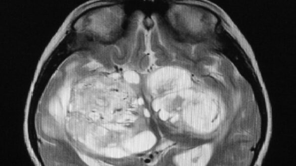 un-virus-del-catarro-modificado-podria-servir-para-tratar-el-cancer-cerebral-mas-letal-en-los-ninos