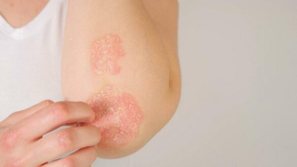 asi-es-tremfya,-el-nuevo-medicamento-aprobado-para-la-artritis-psoriasica