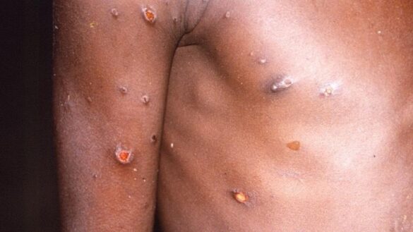 un-experto-de-la-oms-alerta:-la-viruela-del-mono-no-tardara-en-considerarse-pandemia
