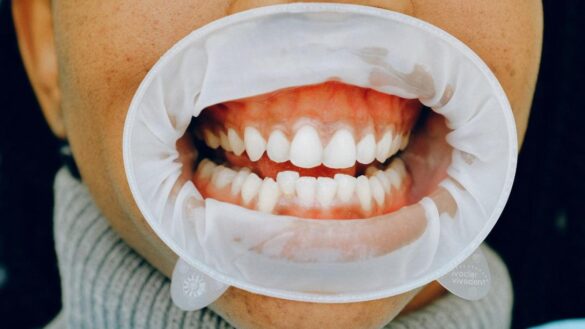 la-enfermedad-periodontal,-una-infeccion-comun-que-aumenta-el-riesgo-de-padecer-alzheimer