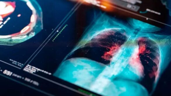 una-nueva-terapia-aumenta-un-20%-la-supervivencia-en-pacientes-con-cancer-de-pulmon-intermedio