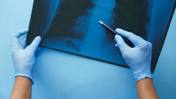 la-sorprendente-consecuencia-del-sindrome-de-down-en-los-huesos:-no-son-capaces-de-sanar-fracturas