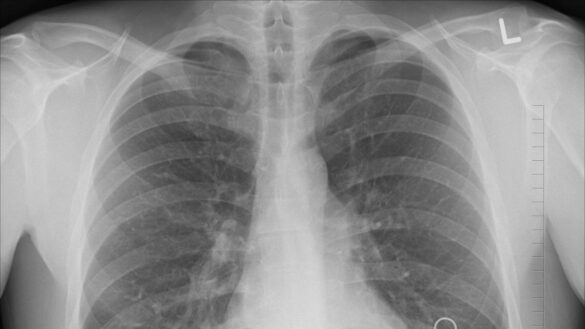 que-es-un-edema-pulmonar,-una-afeccion-que-dificulta-la-respiracion