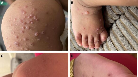 la-gripe-del-tomate,-la-nueva-enfermedad-que-afecta-a-ninos-en-india-y-que-podria-ser-muy-contagiosa