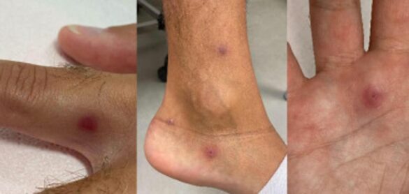 detectan-el-primer-caso-de-coinfeccion-de-covid,-viruela-del-mono-y-vih