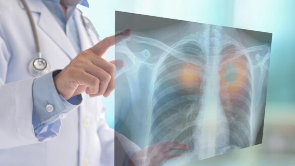 un-tratamiento-experimenta-frena-en-ratones-un-cancer-de-pulmon-mortal