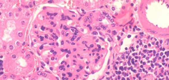 una-innovadora-terapia-permite-superar-el-lupus-a-cinco-pacientes-alemanes
