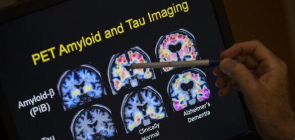 hay-motivos-para-sospechar-que-el-alzheimer-podria-ser-una-enfermedad-autoinmune