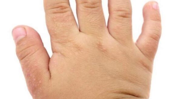 un-novedoso-farmaco-consigue-reducir-la-dermatitis-atopica-en-ninos