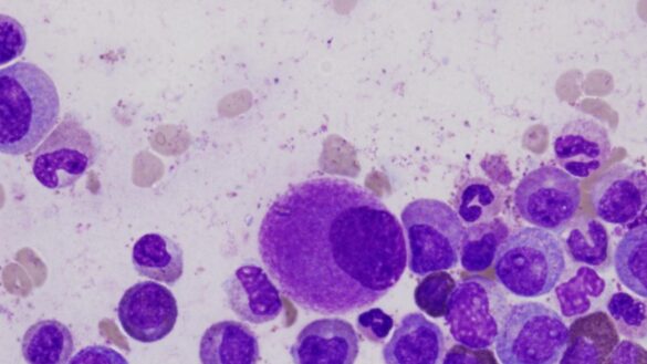 una-terapia-con-ingenieria-genetica-podria-evitar-las-complicaciones-mas-graves-del-tratamiento-de-la-leucemia