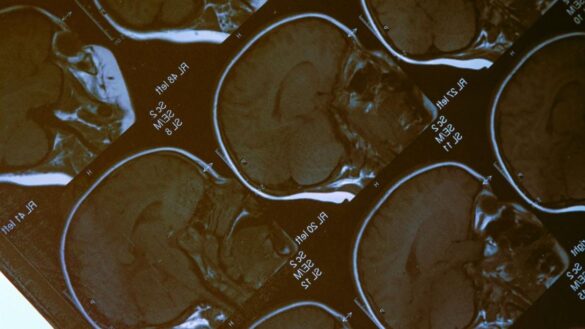 que-es-la-hidrocefalia,-el-problema-por-el-que-han-operado-al-nino-oliver-antes-de-extirpar-su-tumor