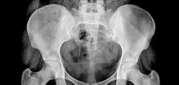 osteoporosis:-que-debemos-comer-para-prevenirla