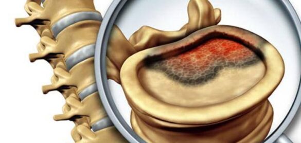asi-es-el-sarcoma-de-ewing,-el-tumor-que-tenia-elena-huelva
