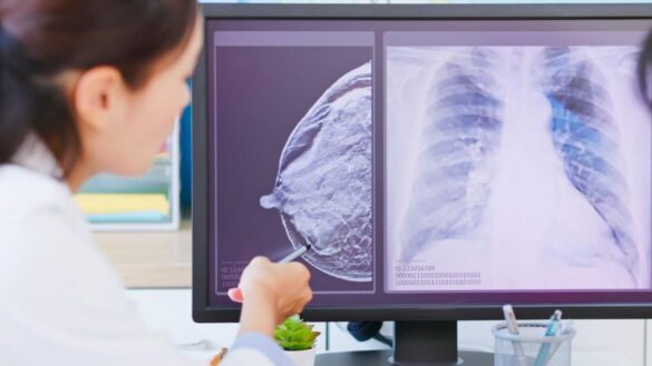 descubren-un-metodo-para-frenar-la-metastasis-del-cancer-de-mama