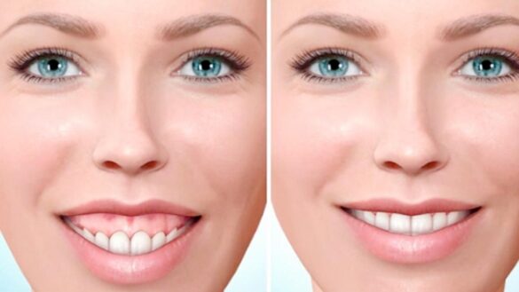 los-tratamientos-mas-eficaces-frente-a-la-sonrisa-gingival