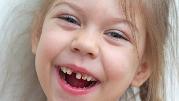 dientes-de-tiza:-sintomas-y-causas-de-esta-enfermedad-dental-que-afecta-a-los-ninos