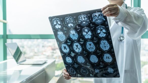 un-neurologo-resuelve-todas-las-dudas-sobre-el-lecanemab,-nuevo-farmaco-contra-el-alzheimer
