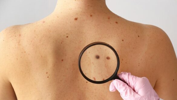 investigadores-logran-bloquear-el-cancer-de-piel-utilizando-piel-humana-artificial