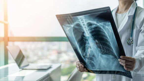 la-mitad-de-los-pacientes-de-cancer-desarrolla-covid-larga,-y-el-riesgo-es-mayor-para-las-mujeres