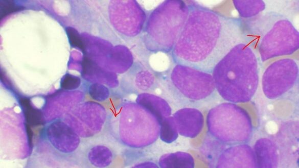 un-medicamento-experimental-logra-curar-la-leucemia-avanzada-en-18-pacientes