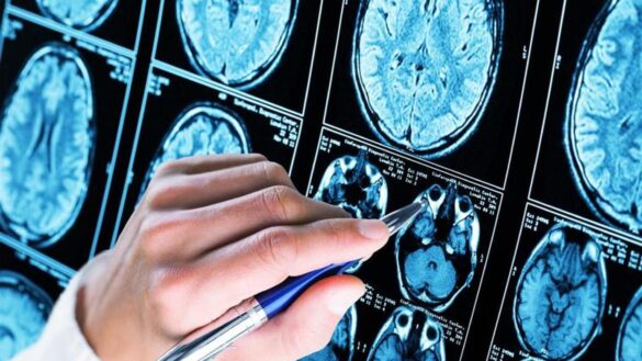 el-fracaso-de-otro-farmaco-prometedor-evidencia-de-nuevo-la-falta-de-conocimiento-sobre-el-alzheimer